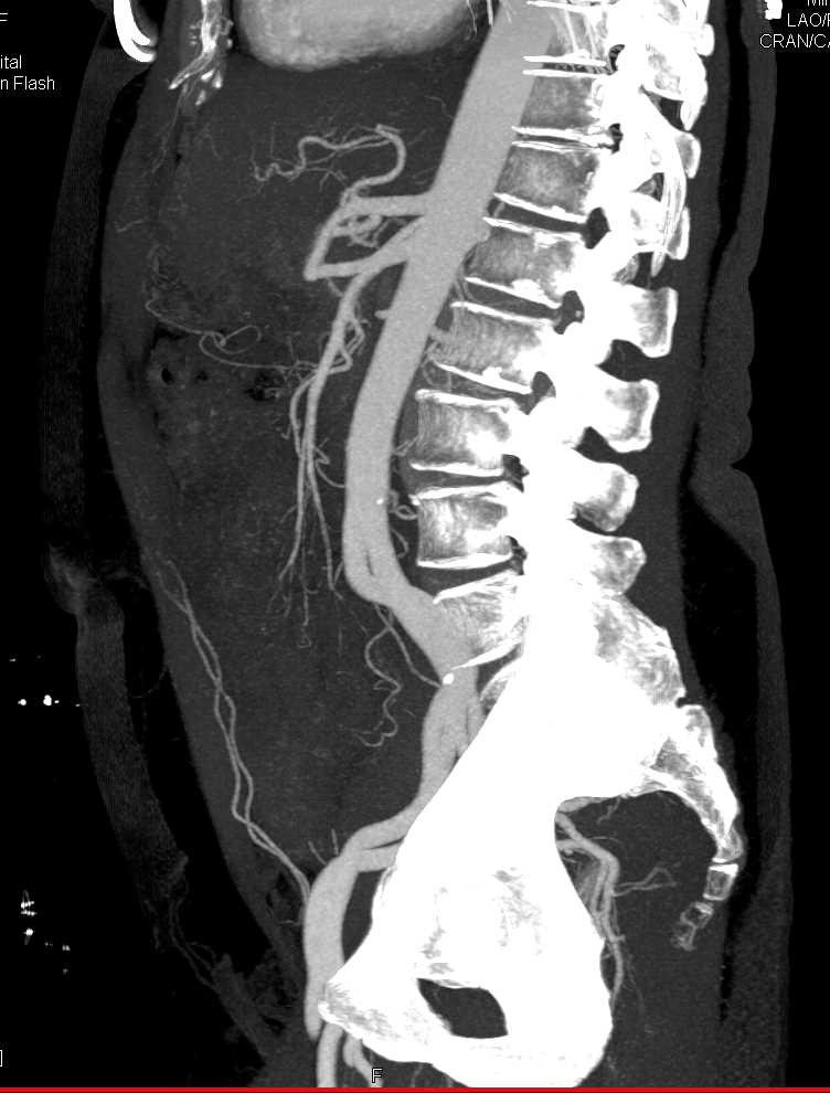 Diverticulitis Sigmoid Colon - CTisus CT Scan
