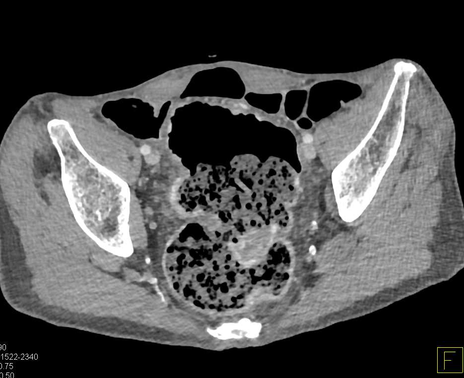 Rectal Cancer - CTisus CT Scan