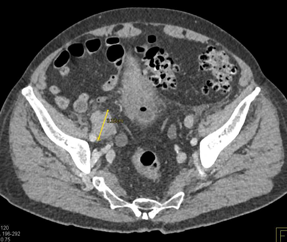 Diverticulitis with Fistulae to the Bladder - CTisus CT Scan