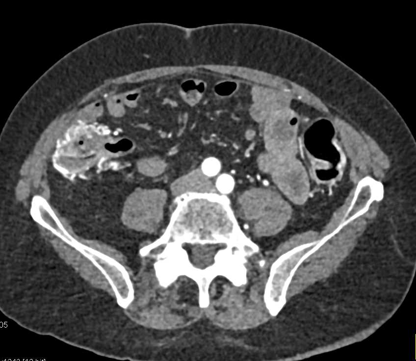 Angiodysplasia Cecum and Ascending Colon - CTisus CT Scan