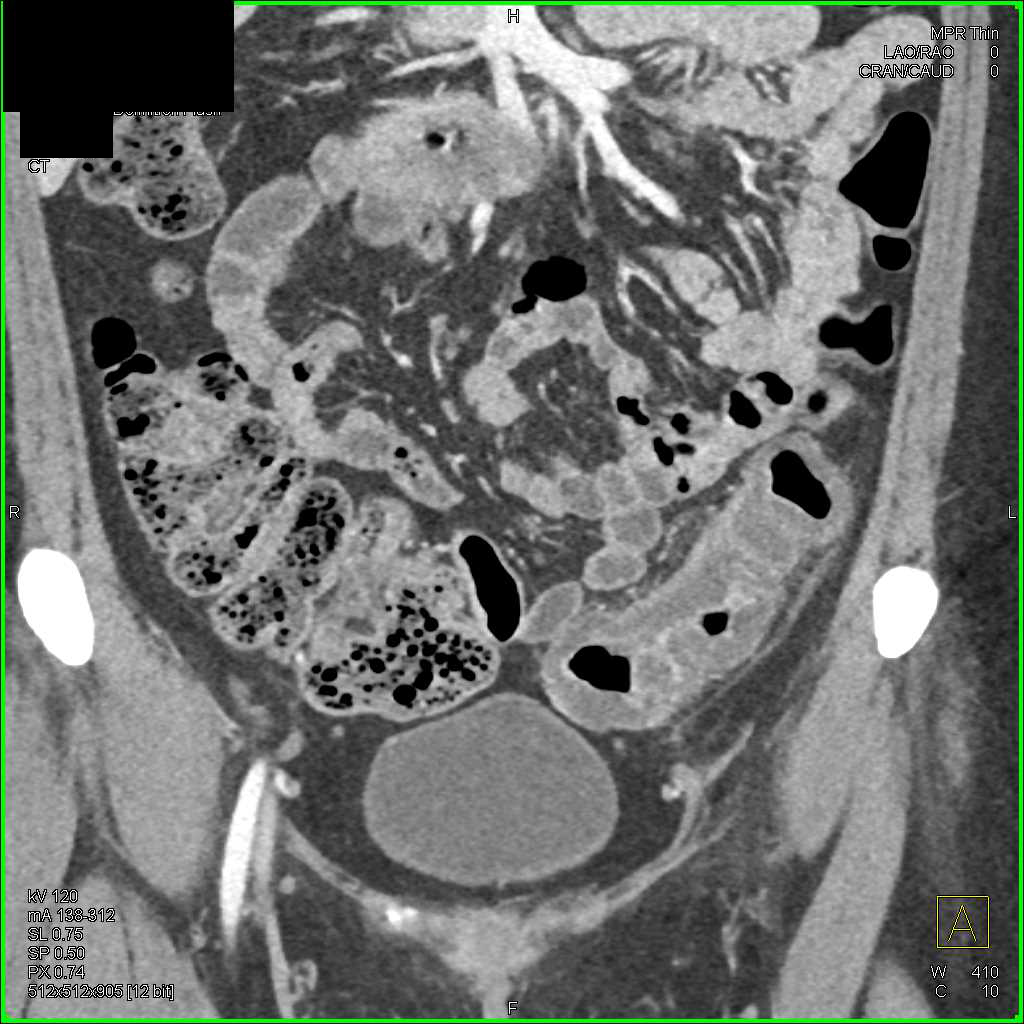 Ischemic Colitis Descending Colon - CTisus CT Scan
