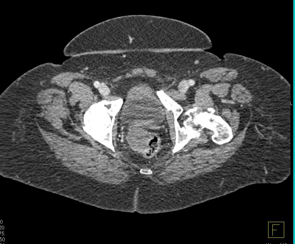 Rectal Cancer in a Patient with a History of Ulcerative Colitis - CTisus CT Scan
