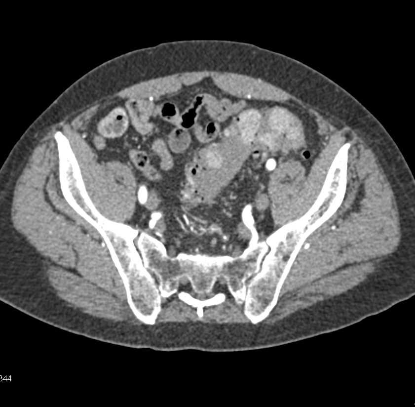 Gastrointestinal (GI) Bleed due to Diverticulitis - CTisus CT Scan