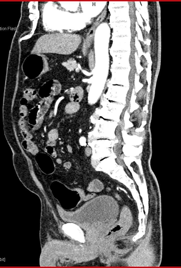 Colitis Involves Sigmoid Colon and Rectum - CTisus CT Scan