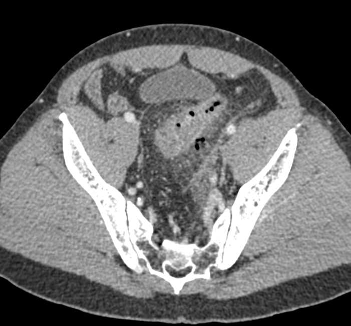 Diverticulitis with Focal Perforation - CTisus CT Scan