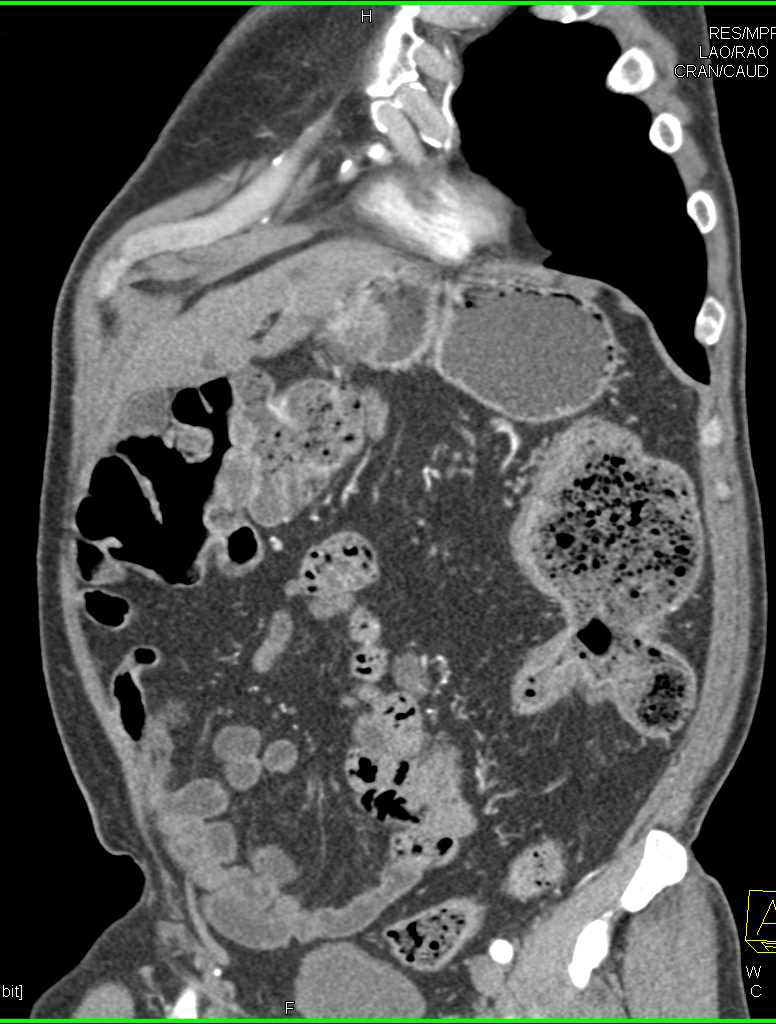 Crohn's Disease with Stricture Descending Colon - CTisus CT Scan
