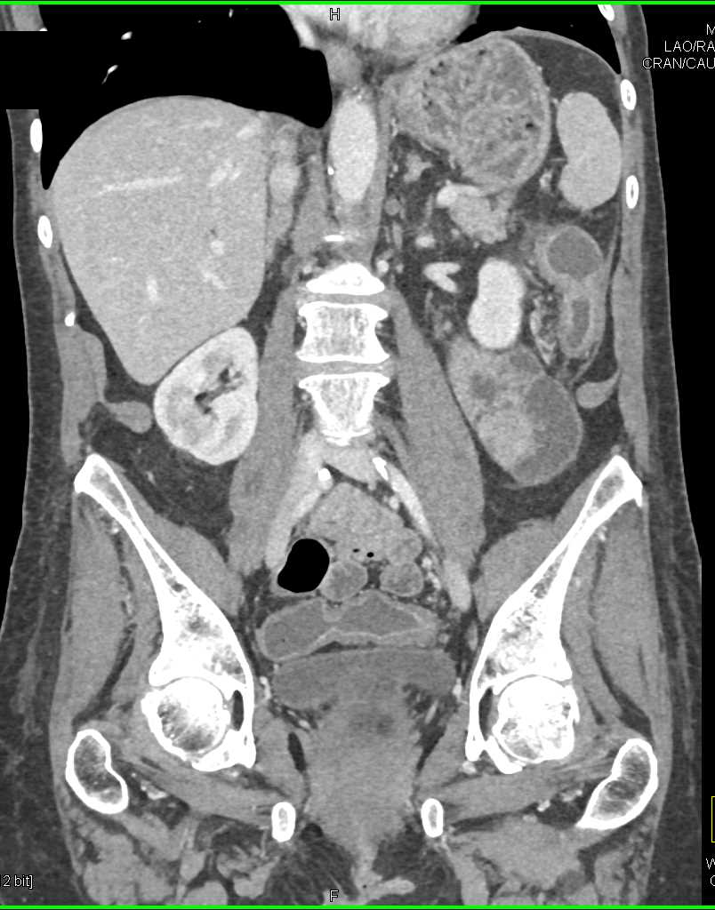 Colitis Left Colon - CTisus CT Scan