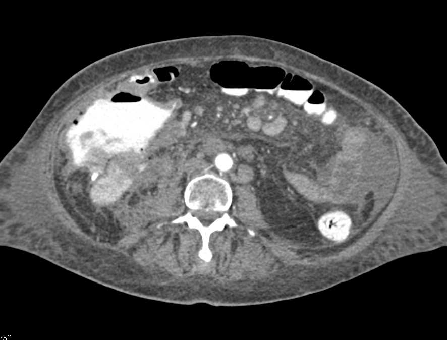 Ulcerating Cecal Carcinoma - CTisus CT Scan