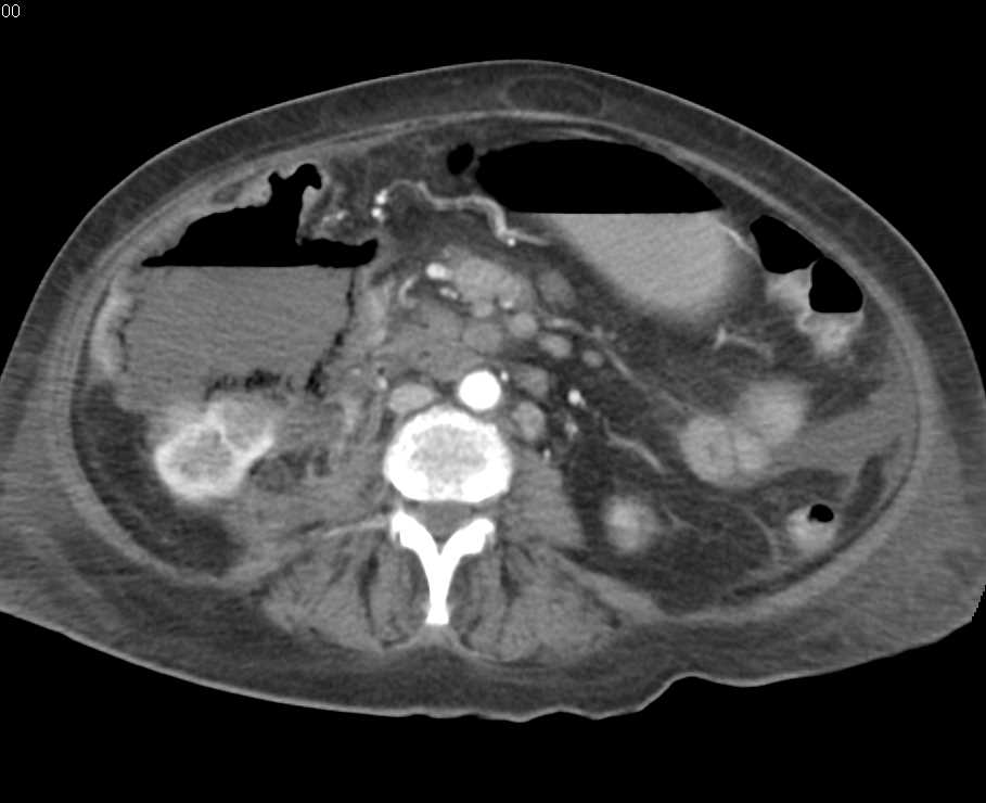 Ulcerating Cecal Carcinoma - CTisus CT Scan