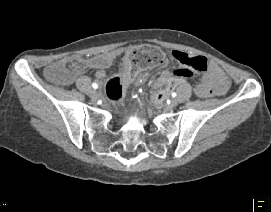Sigmoid Colon Cancer - CTisus CT Scan