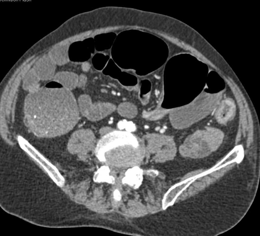 Colitis with Colonic Stricture - CTisus CT Scan