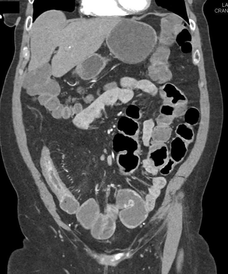 Crohn's Disease with Fibrofatty Mesentery - CTisus CT Scan
