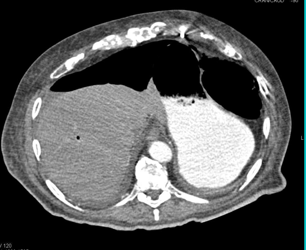 Pneumatosis Cecum with Pneumoperitoneum - CTisus CT Scan