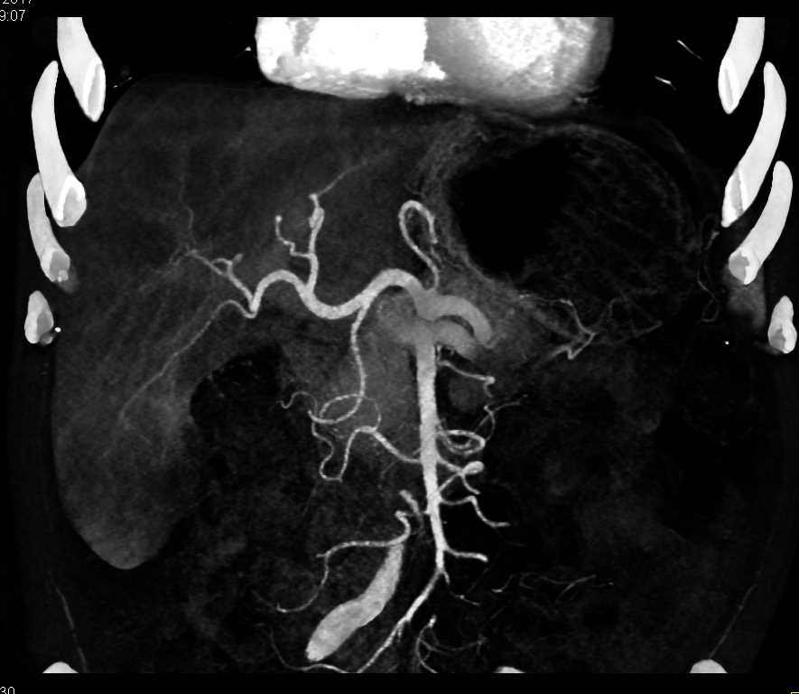 Cancer at Sigmoid-Rectal Junction - CTisus CT Scan