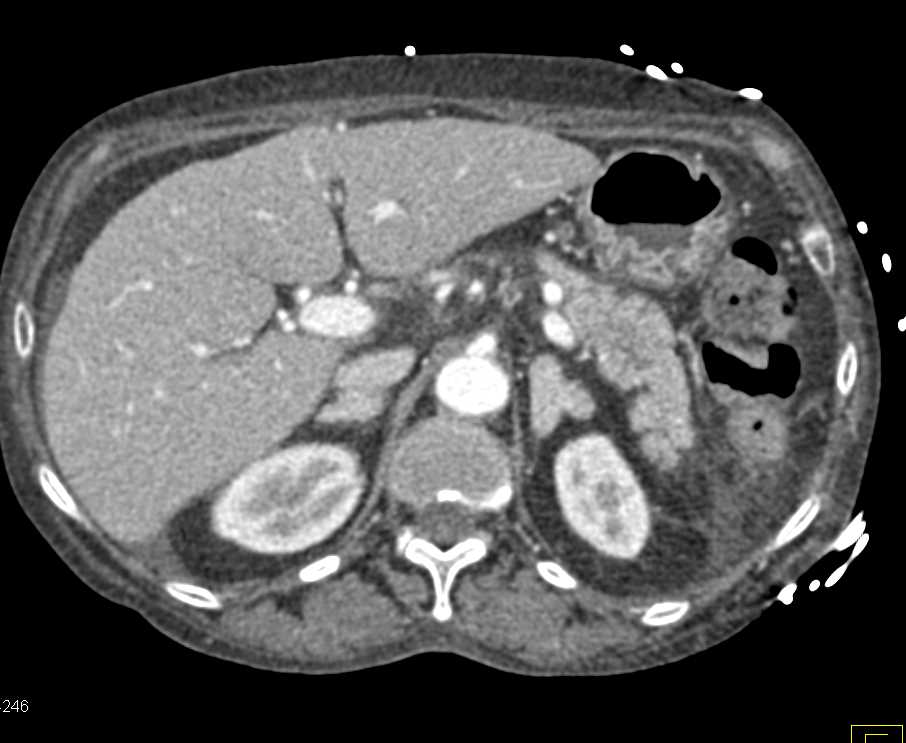 Lipoma in the Right Colon with Small Cell Lung Cancer - CTisus CT Scan