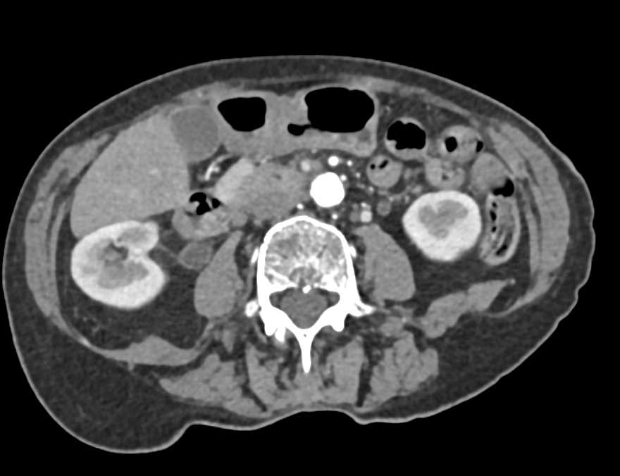 Cecal Carcinoma - CTisus CT Scan