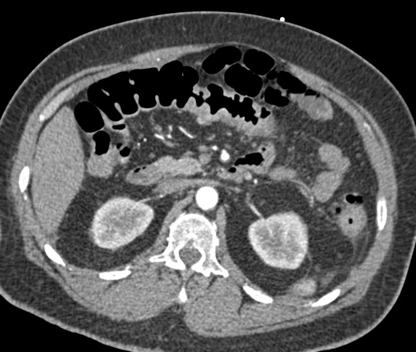 Colitis of the Colon - CTisus CT Scan