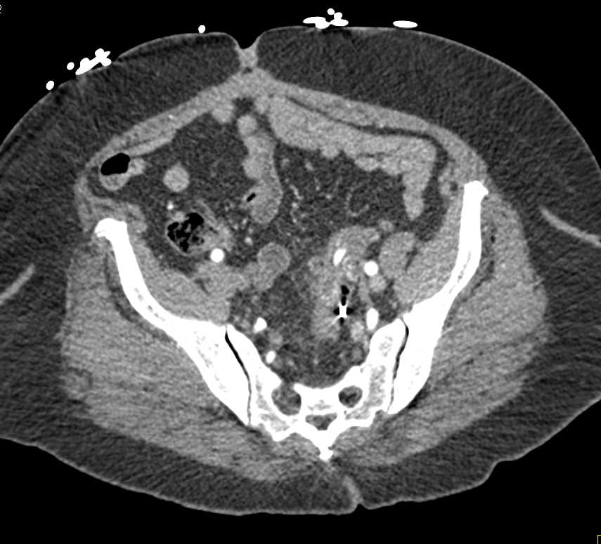 Active Bleed in Descending Colon - CTisus CT Scan