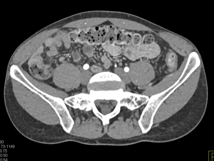 Ulcerative Colitis with Rectal Bleed - CTisus CT Scan