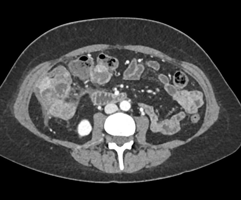Colon Cancer with Carcinomatosis - CTisus CT Scan