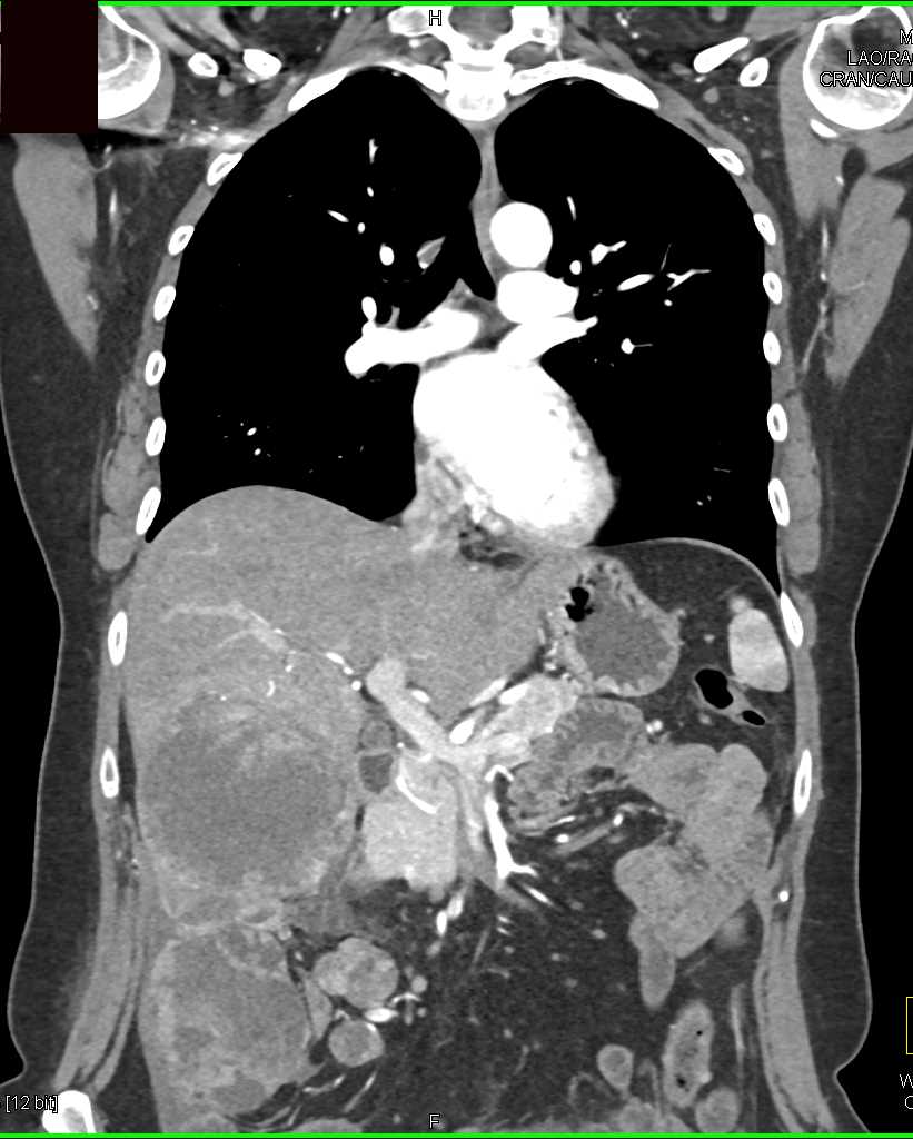 Carcinomatosis due to Colon Cancer - CTisus CT Scan