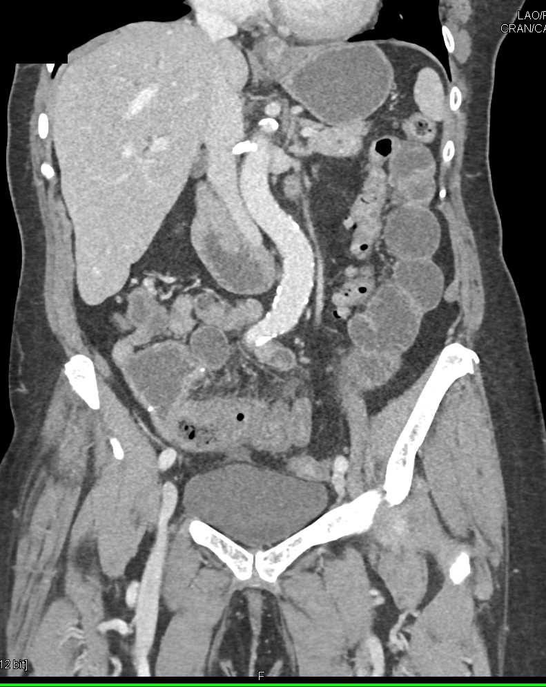 Feces Sign Terminal Ileum with Concern for Distal Small Bowel Obstruction by mass - CTisus CT Scan