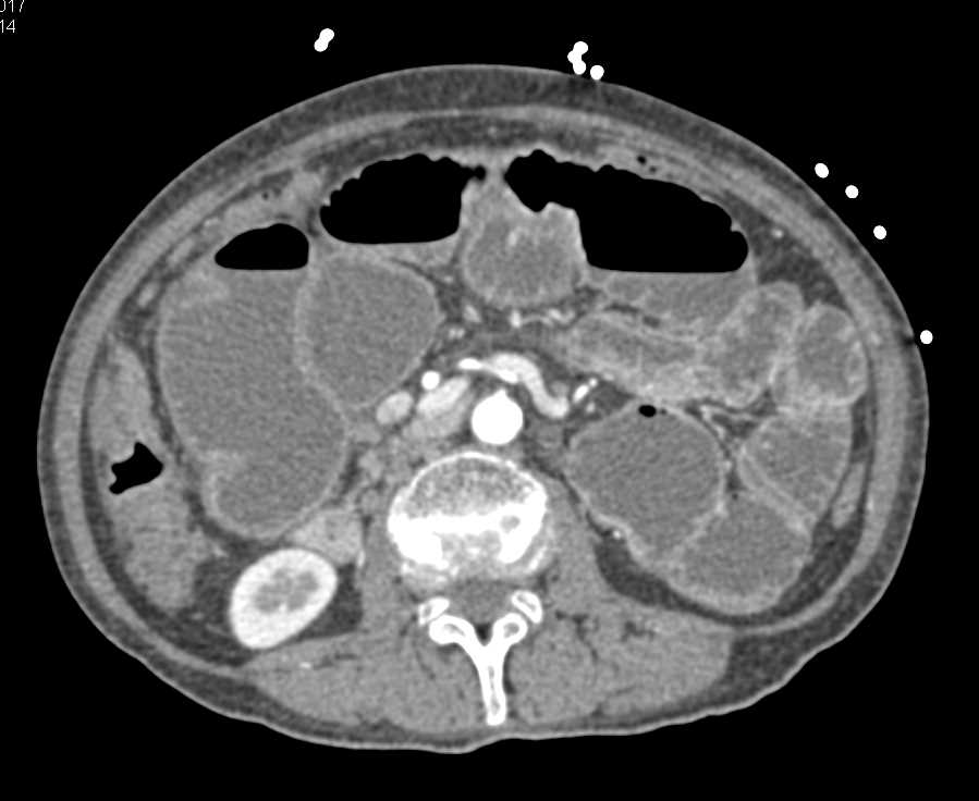 Carcinoma Cecum Obstructs the Small Bowel and Also Liver Metastases - CTisus CT Scan