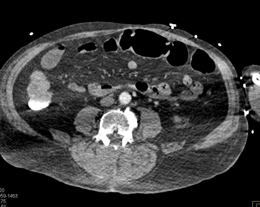Rectal Bleed - CTisus CT Scan