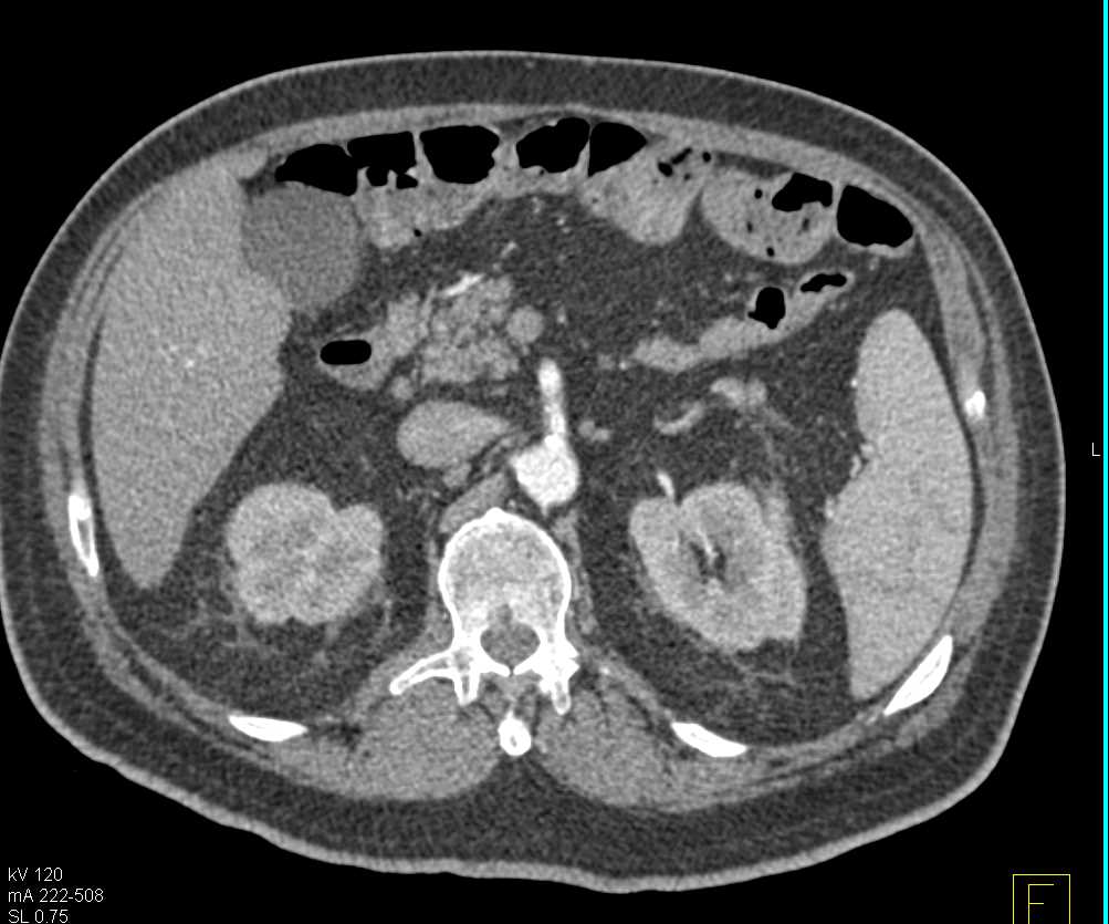 Recurrent Rectal Cancer Invades the Sacrum - CTisus CT Scan