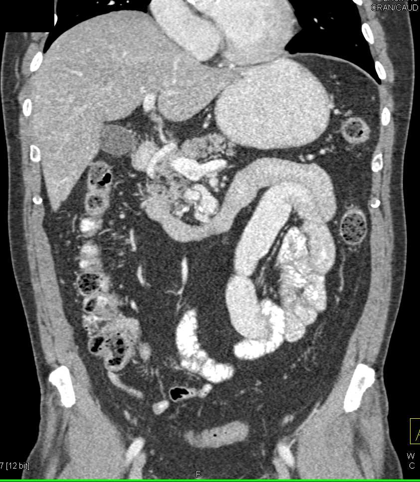 Colitis Colon Especially Right Colon and Transverse Colon - CTisus CT Scan