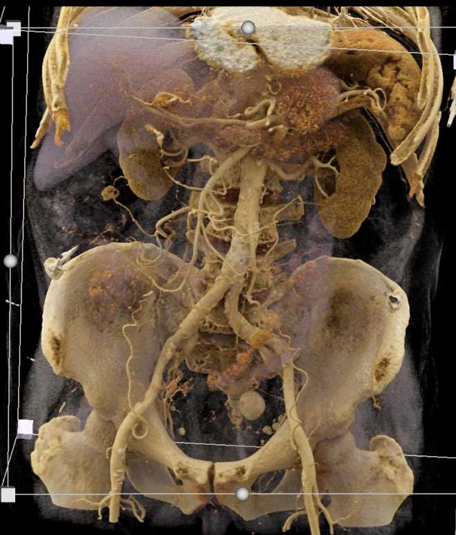 Diverticular Disease - CTisus CT Scan