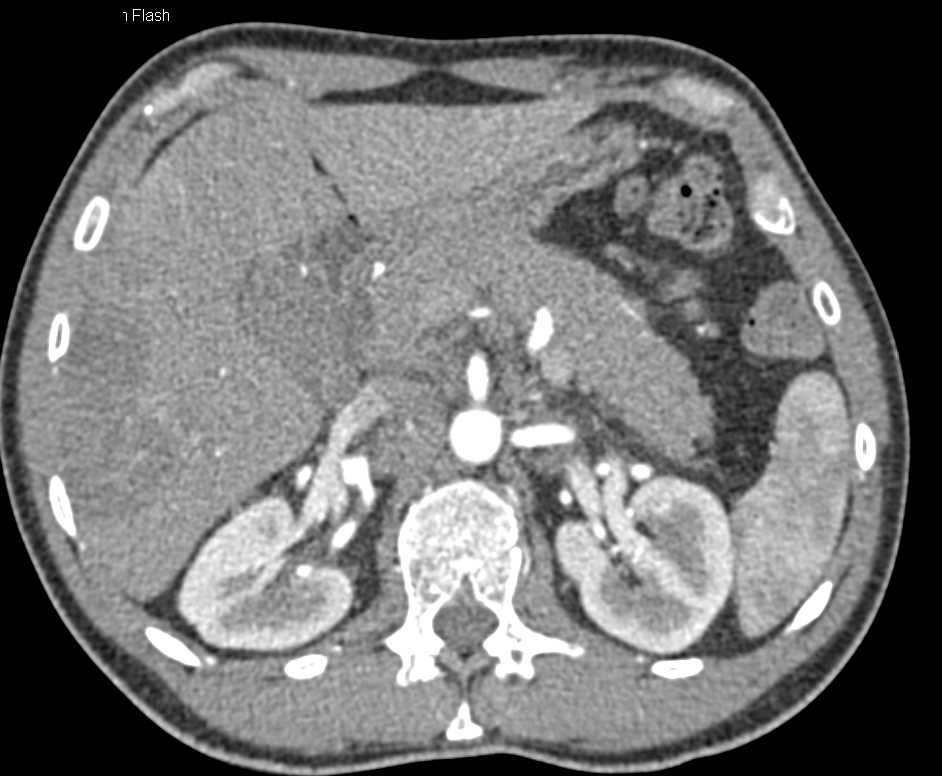 Cecal Cancer with Liver Metastases - CTisus CT Scan