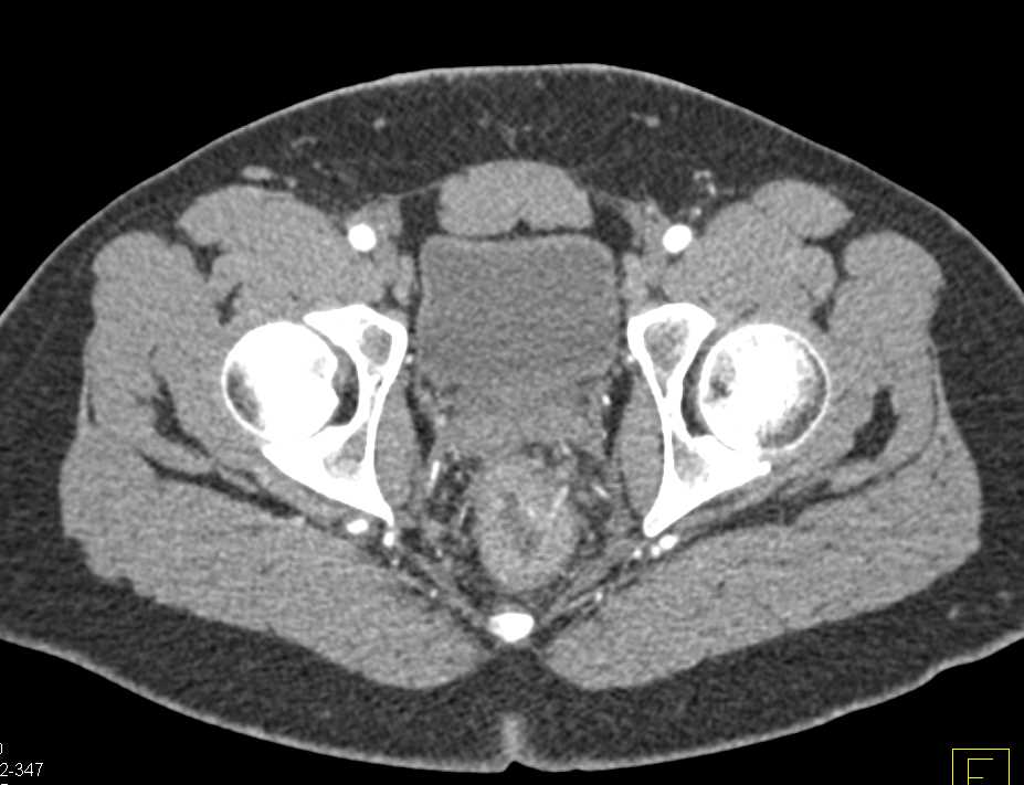 Proctitis Rectum - CTisus CT Scan