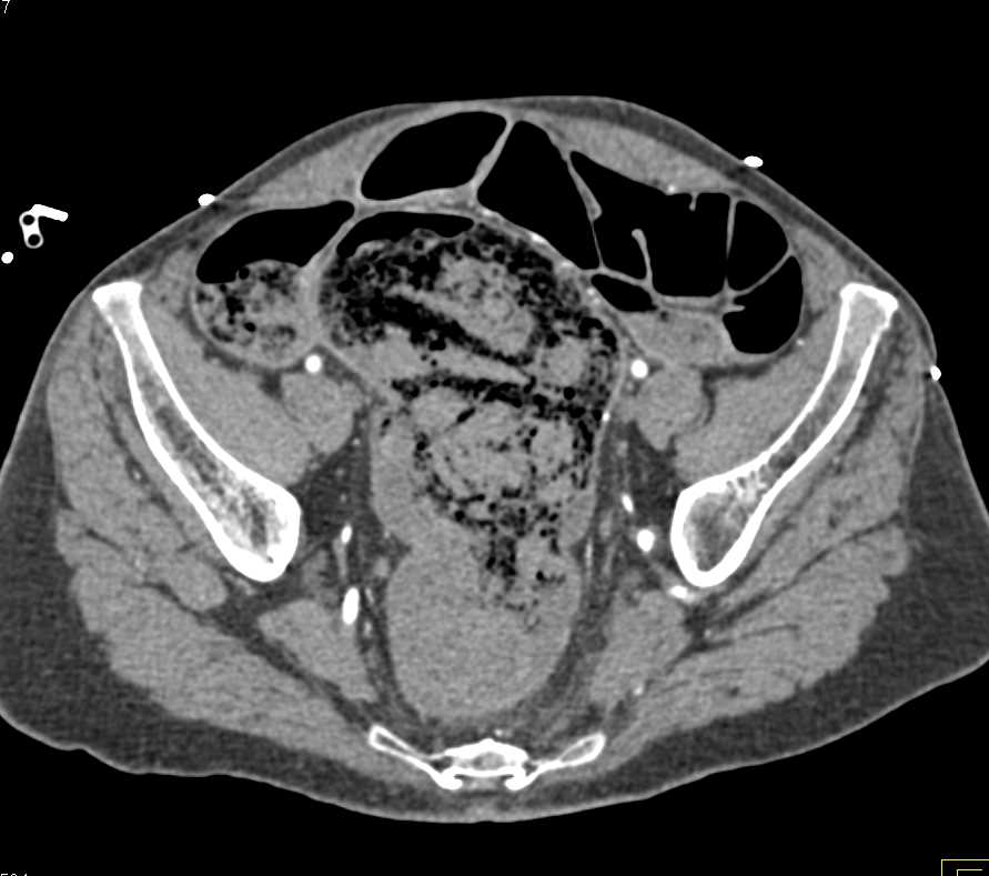 Rectal Bleed - CTisus CT Scan