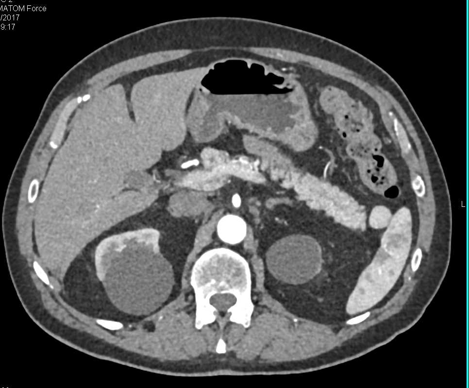 Acute Colitis Involves the Rectum and an Enlarged Prostate - CTisus CT Scan
