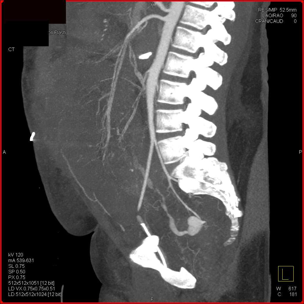 Active Bleed in the Sigmoid Colon - CTisus CT Scan