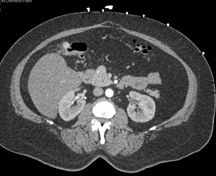 Acute Bleed Right Colon due to Diverticular Disease - CTisus CT Scan