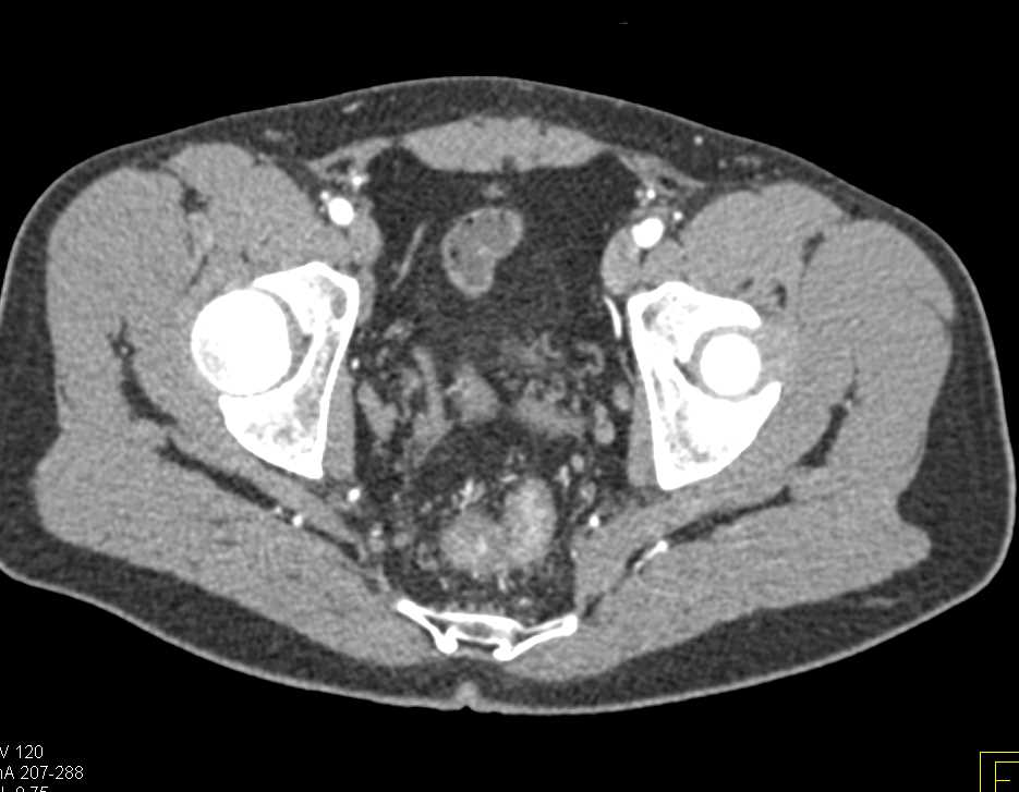 Proctitis with Rectal Varices - CTisus CT Scan