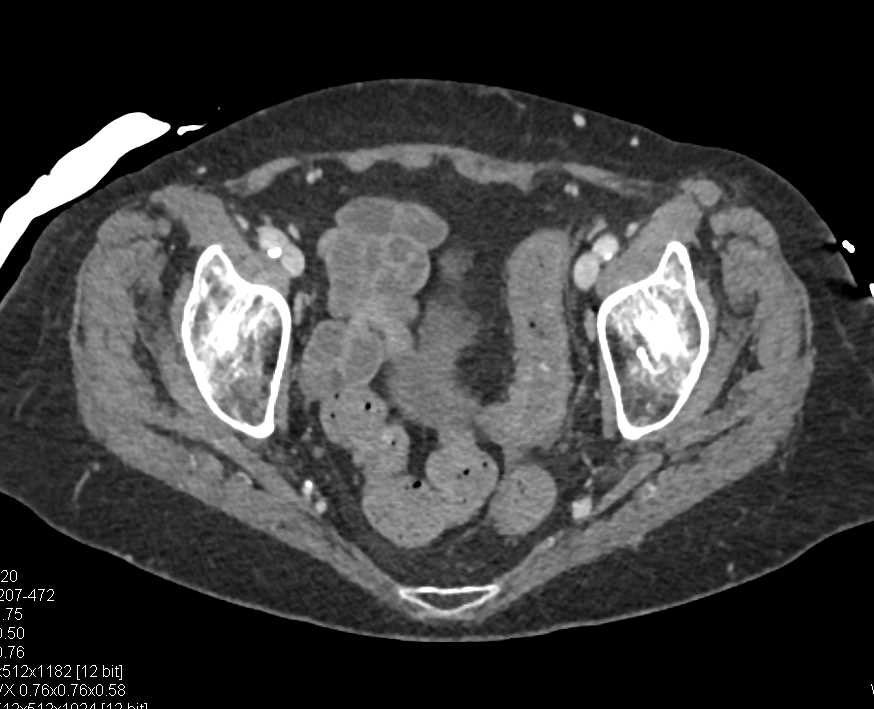 Ulcerative Colitis - CTisus CT Scan