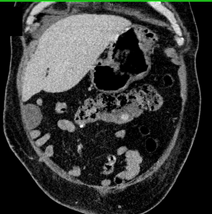 Diverticulum Transverse Colon - CTisus CT Scan