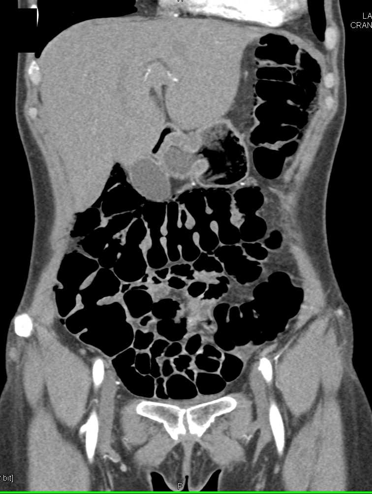 Pneumatosis Colon Colon Case Studies Ctisus Ct Scanning