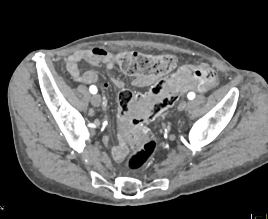 Colitis with Fistulae from Colon to the Bladder - CTisus CT Scan