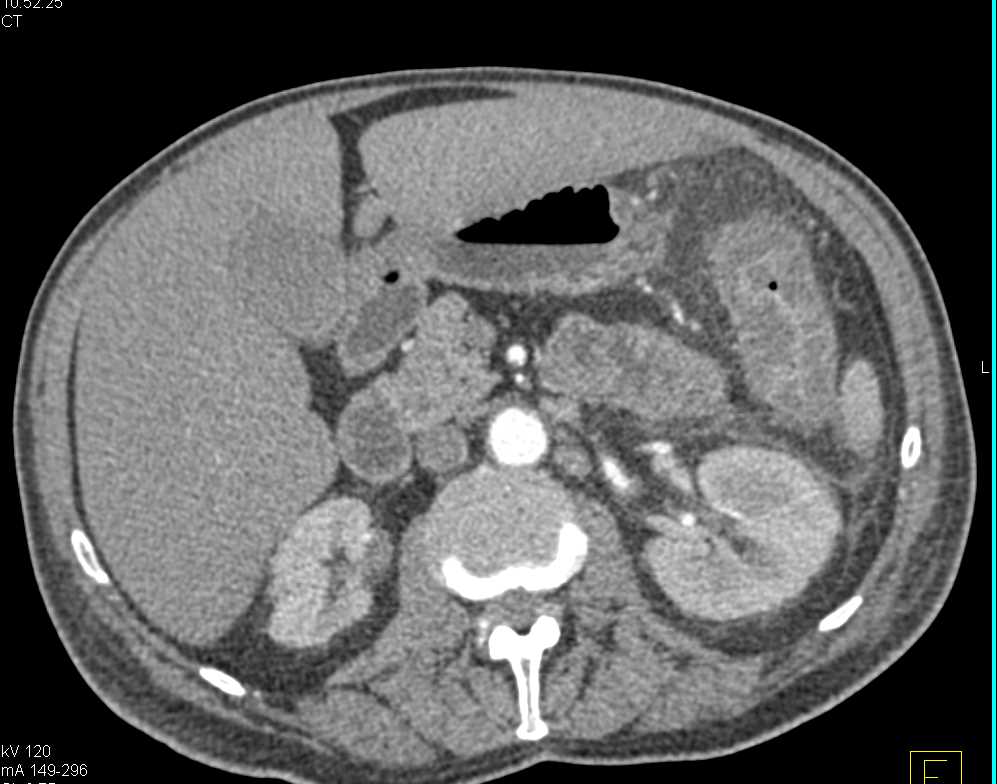 Pseudomembranous Colitis - CTisus CT Scan
