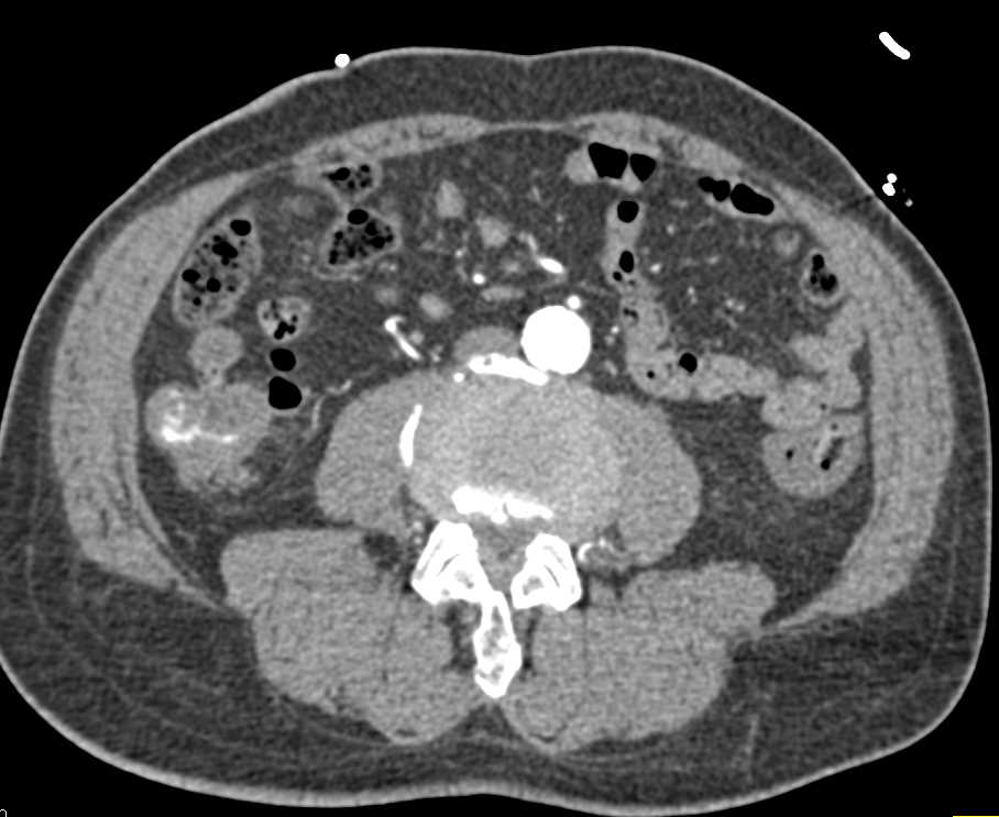 Active Gastrointestinal (GI) Bleed in Right Colon - CTisus CT Scan