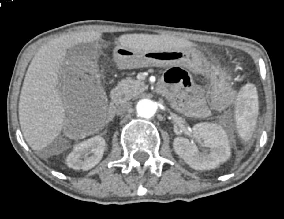 Ulcerative Colitis with Stricture Near Splenic Flexure - CTisus CT Scan