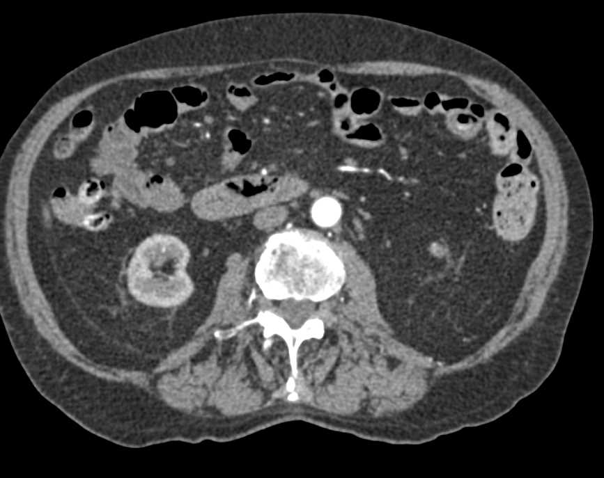 Diverticular Bleed Descending Colon - CTisus CT Scan