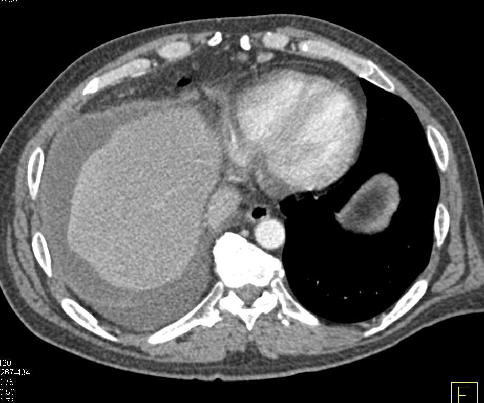 Pneumatosis Cecum - CTisus CT Scan