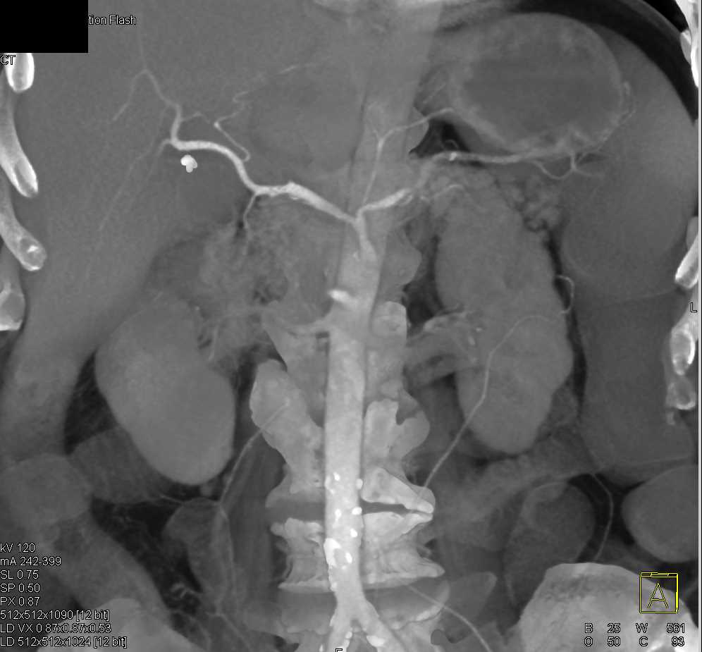 Colitis Right Colon - CTisus CT Scan