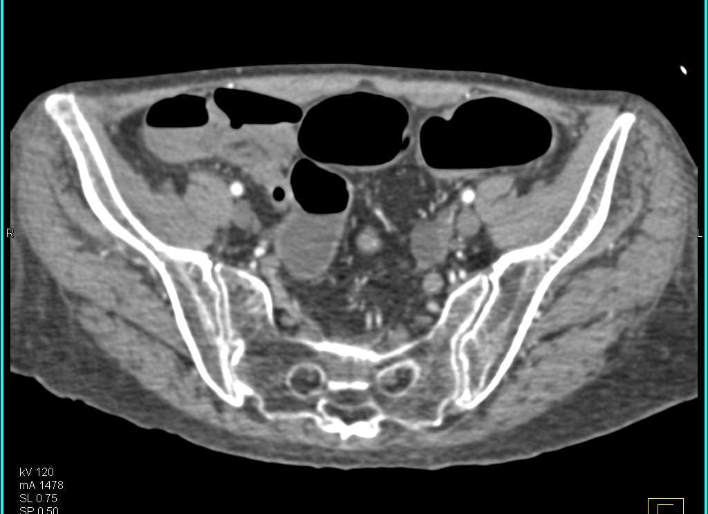 Infectious Colitis - CTisus CT Scan