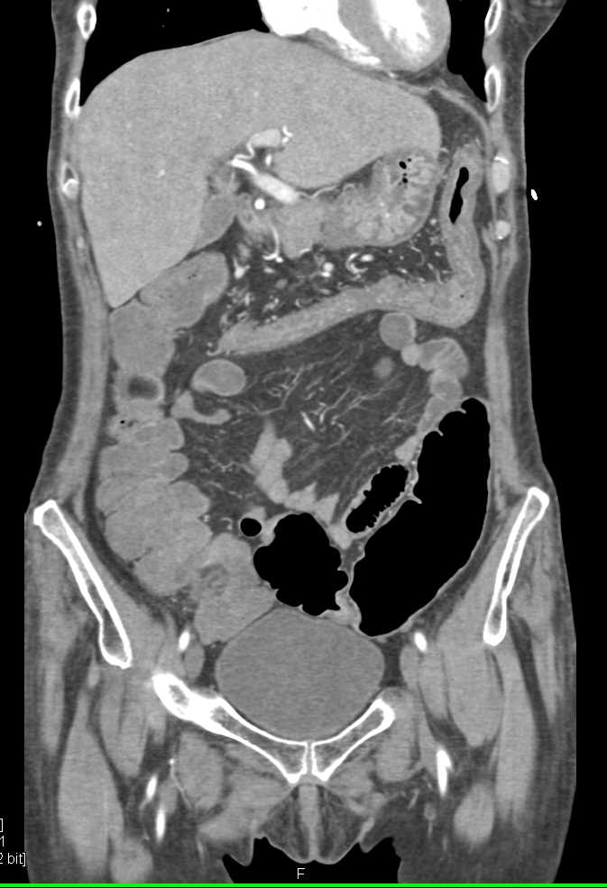 Infectious Colitis - CTisus CT Scan